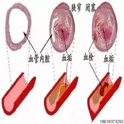 玉林中醫院開展三氧大自血療法