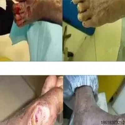 創(chuàng)面修復：三氧治療糖尿病足的優(yōu)勢